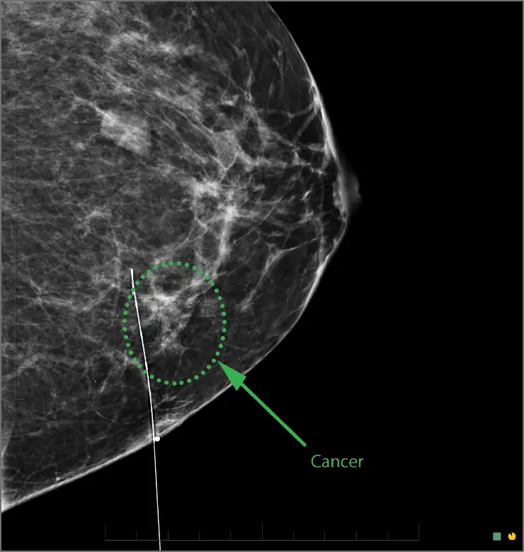 A breast with a hook wire placed near the non-palpable breast cancer just before the surgery