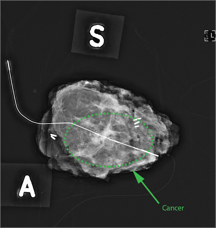 The operative specimen - breast cancer can be seen along the middle of the wire.