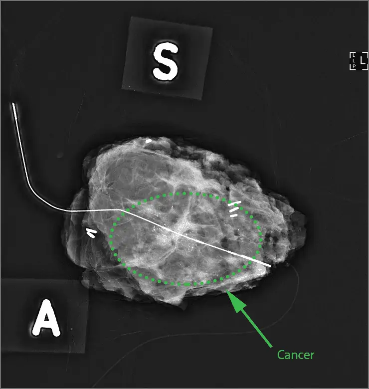 The operative specimen - breast cancer can be seen along the middle of the wire.