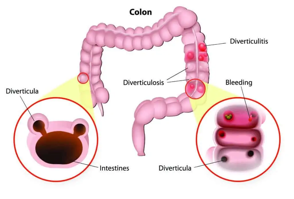 Diverticulitis infographic showing the colon