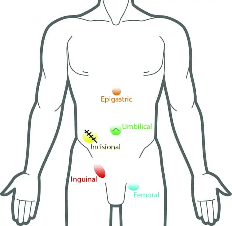 Hernia infographic showing the most common locations for hernias
