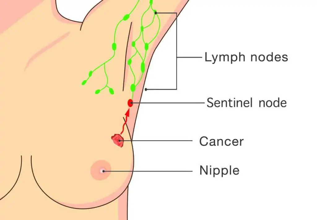 An infographic showing what is a sentinel lymph node
