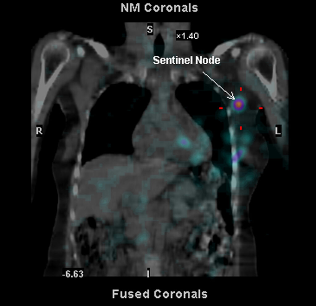 Scan showing the Sentinel Node