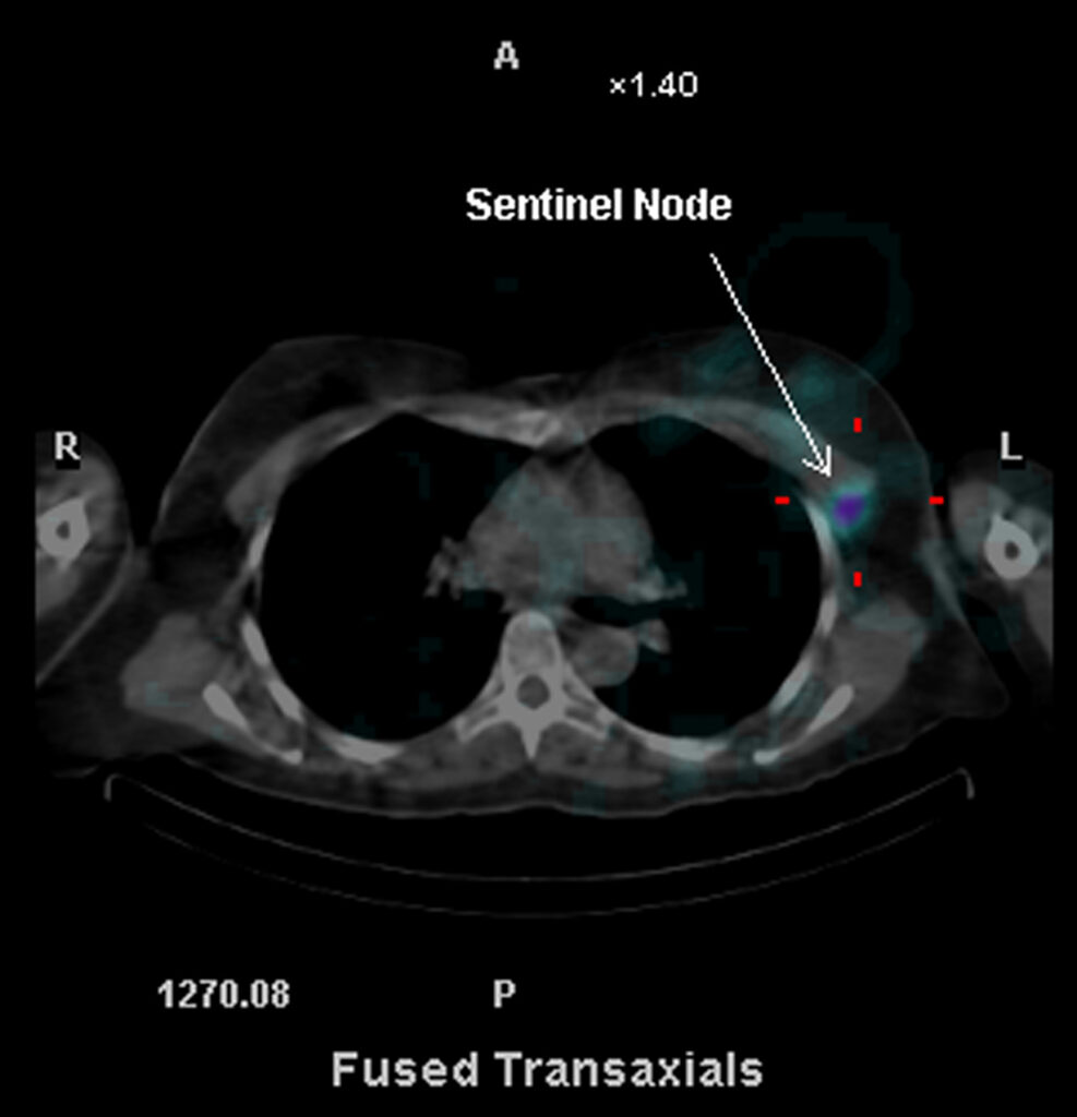 Cross section scan showing the Sentinel Node