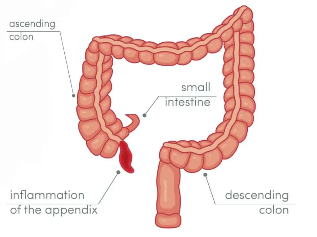 Appendicitis infographic