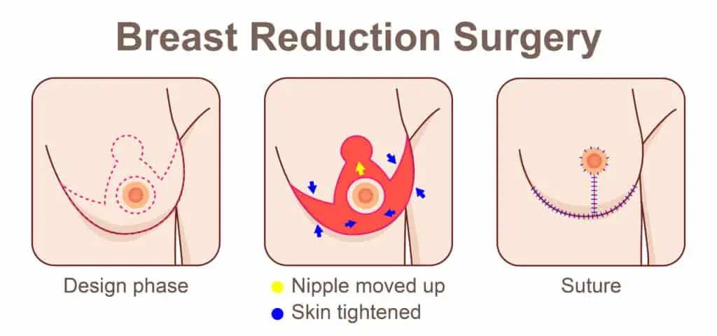 Breast reduction surgery infographic