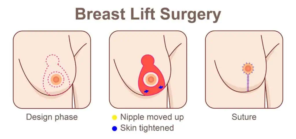 Breast lift surgery infographic