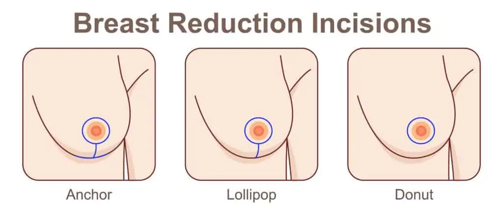Breast reduction incisions infographic